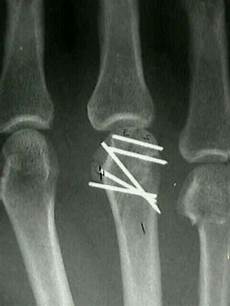 Screws