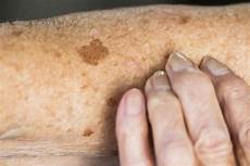 Skin Analyzer
