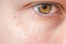 Skin Analyzer
