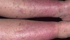 Skin Analyzer