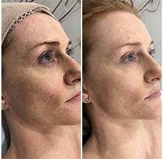 Skin Rejuvenation Equipment
