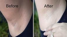 Skin Whitening