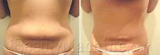 Ultrasonic Skin Rejuvenation