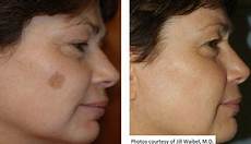Ultrasonic Skin Rejuvenation
