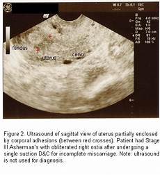 Ultrasound Therapy
