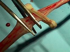 Umbilical Cutter