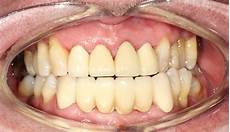 Veneers