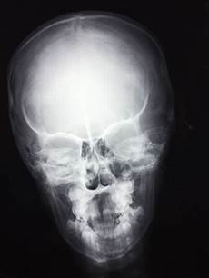 X Ray Tube