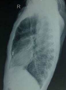 X Ray Tube