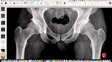 Xray Tube