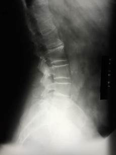 Xray Tube