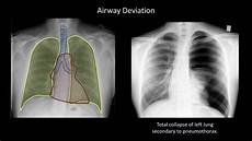 Xray Tube